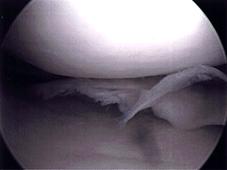 BEFORE photo of meniscus tear